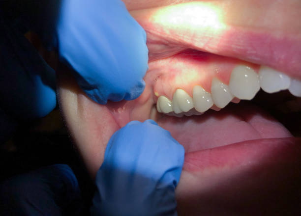 Best Emergency Wisdom Tooth Extraction in Central Garage, VA